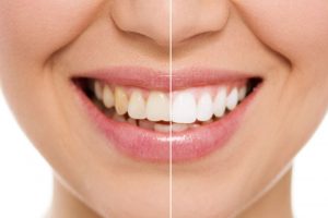 Teeth Whitening at your Vancouver dental clinic